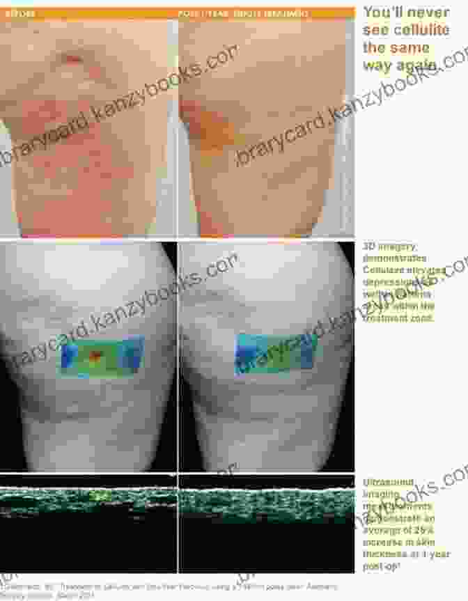 Before And After Photo Of Thighs With Reduced Cellulite Get Rid Of Cellulite Thighs And Ugly Leg Fat