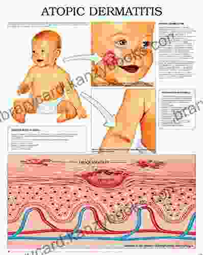 Atopic Dermatitis: Full Illustrated Bruce R Ellig